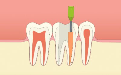 FALSOS MITOS DE LA ODONTOLOGIA. LA ENDODONCIA.