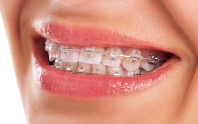 Tipos de brackets: Guía completa para elegir la mejor opción.